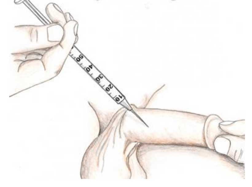 Injection Papaverine Intracavernosal injection