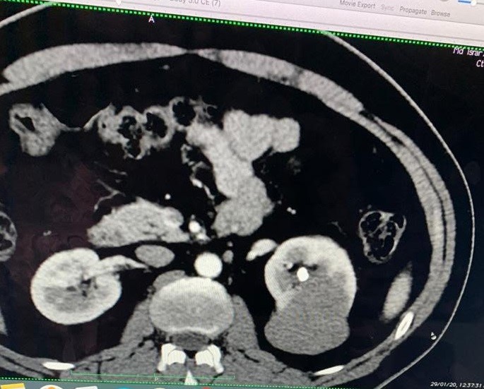 Kidney cancer CT Scan Dr Ashish Sabharwal