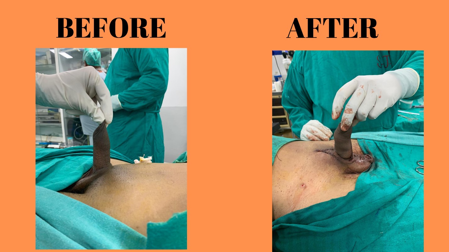 Surgery to get a bigger dick