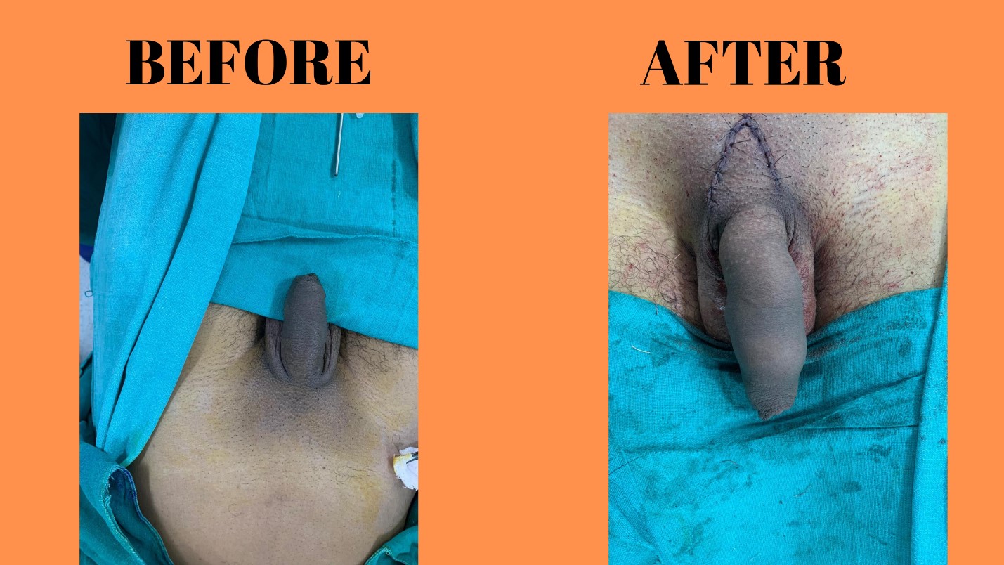 Penile Lengthening