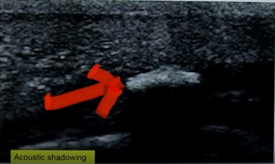 Peyronie’s disease on Ultrasound