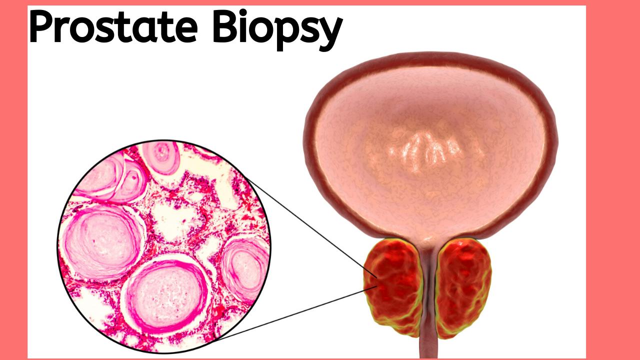 Prostate biopsy in Delhi