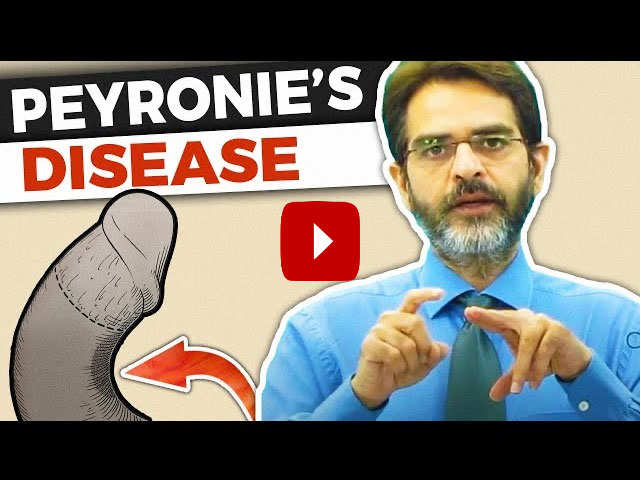 peyronie's disease in Hindi : treatment of Curved Penis or Bent penis