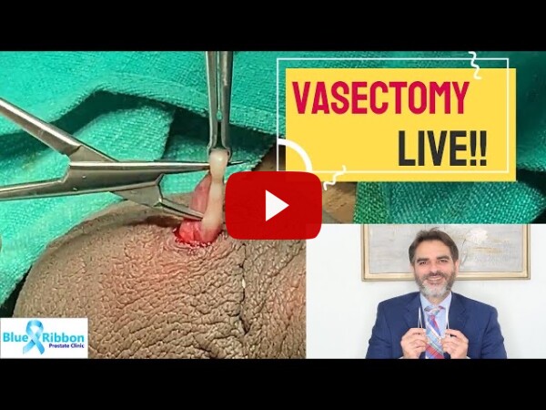 No Scalpel Vasectomy in New Delhi, India Live!! Best male family planning operation